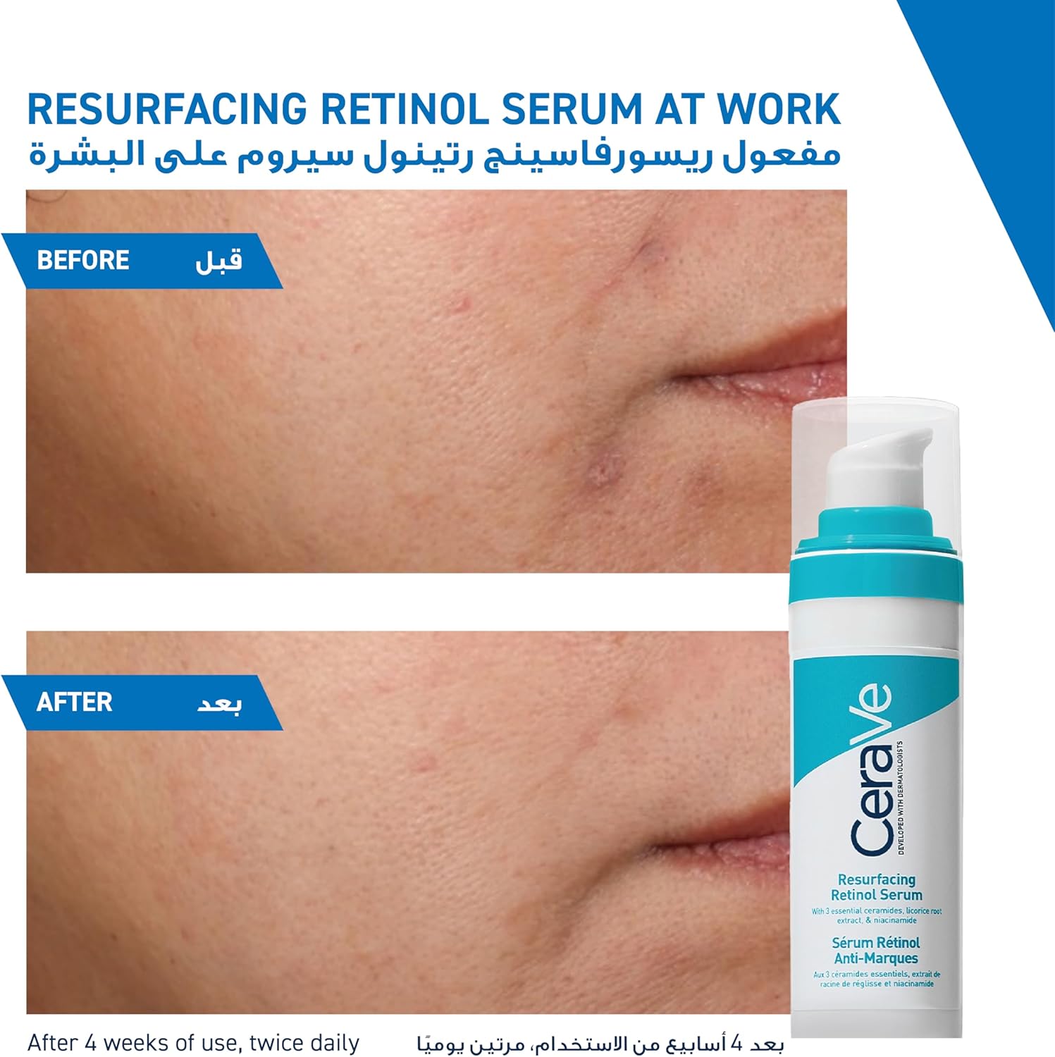 CeraVe Resurfacing Retinol Serum for Post-Acne Marks & Smooth Skin